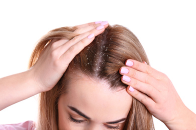 Image of Woman with dandruff in her hair on white background, closeup