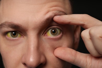 Man checking his health condition on black background, closeup. Yellow eyes as symptom of problems with liver