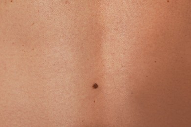 Closeup of man's body with birthmarks as background