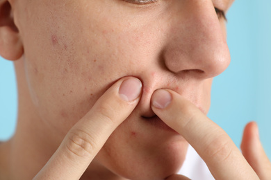 Teen guy with acne problem squeezing pimple on light blue background, closeup