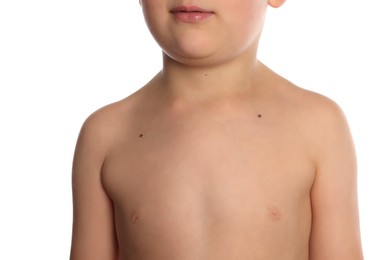 Closeup view of boy's body with birthmarks on white background
