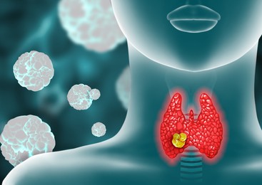 Illustration of human thyroid cancer on color background