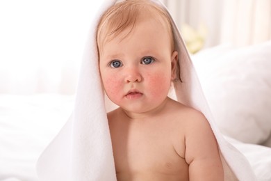 Cute little baby with allergy symptoms on cheeks at home