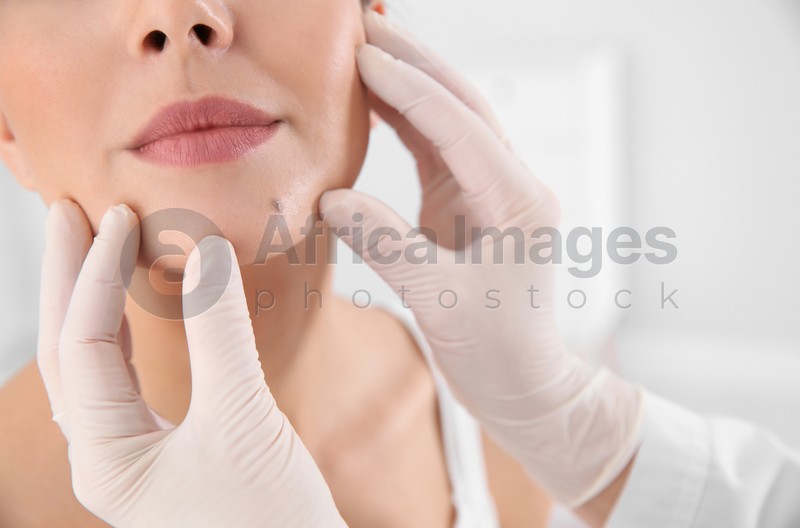 Dermatologist examining patient's birthmark in clinic, closeup