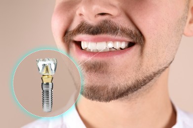 Man with beautiful smile after dental implant installation procedure on beige background, closeup