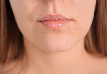 Young woman with acne problem, closeup