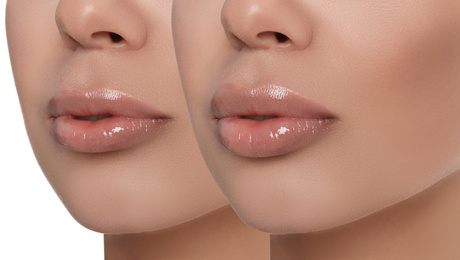 Woman before and after lip correction procedure, closeup