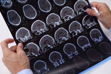 Doctor examining MRI images of patient with multiple sclerosis at white table, closeup