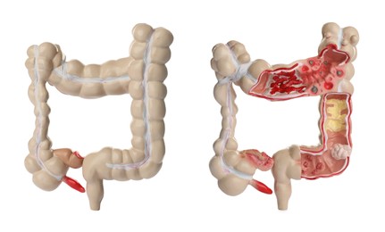 Anatomical model of large intestine on white background, collage. Gastroenterology