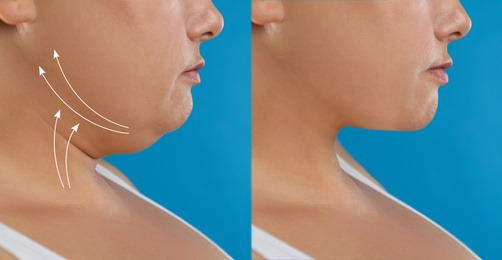 Woman before and after plastic surgery operation on blue background, closeup. Double chin problem 