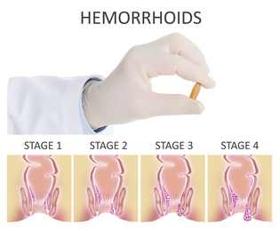 Image of Doctor holding suppository for hemorrhoid treatment over illustration of lower rectum progressing disease