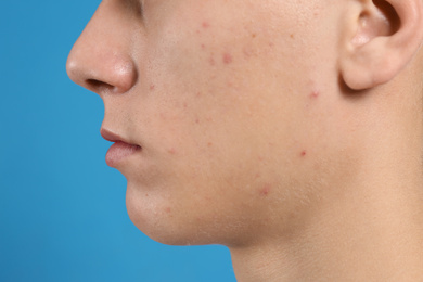 Teen guy with acne problem on blue background, closeup