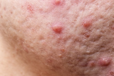 Young woman with acne on her face, closeup