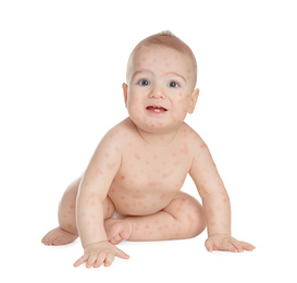 Little child with red rash on white background. Baby allergies