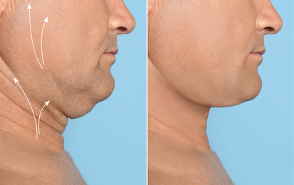 Mature man before and after plastic surgery operation on blue background, closeup. Double chin problem 