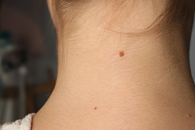 Closeup view of woman's neck with birthmarks