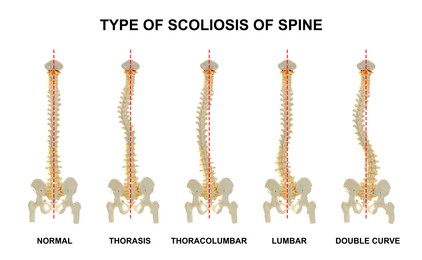 Illustration of Medical poster demonstrating types of scoliosis on white background. Illustration of healthy and diseased spine