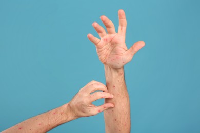 Man with rash suffering from monkeypox virus on light blue background, closeup. Space for text