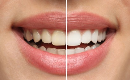 Collage with photos of woman before and after teeth whitening, closeup