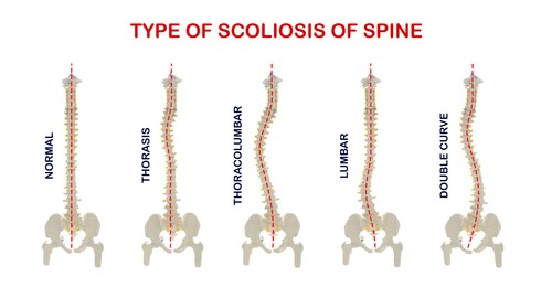 Illustration of Medical poster demonstrating types of scoliosis on white background. Illustration of healthy and diseased spine