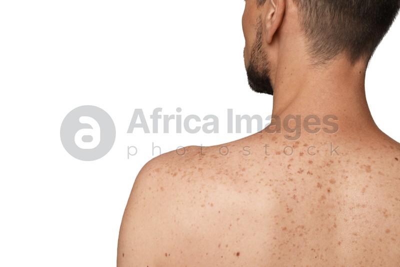 Closeup of man`s body with birthmarks on light grey background, back view. Space for text