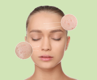 Young woman with acne problem on light green background