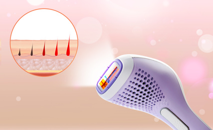 Epilation procedure. Modern appliance and illustration of hair follicle growth on pink background
