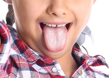 Little girl showing tongue with white patches, closeup. Oral candidiasis (thrush) disease