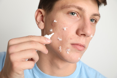 Teen guy with acne problem applying cream on light background, closeup