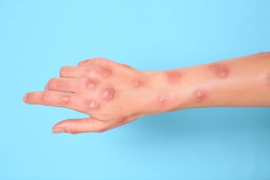 Photo of Woman with rash suffering from monkeypox virus on light blue background, closeup