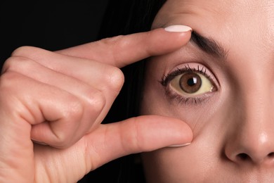 Woman checking her health condition on black background, closeup. Yellow eyes as symptom of problems with liver