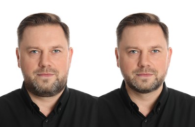 Image of Double chin problem. Collage with photos of mature man before and after plastic surgery procedure on white background