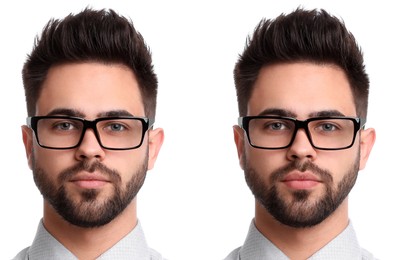 Collage with photos of man before and after lips augmentation on white background
