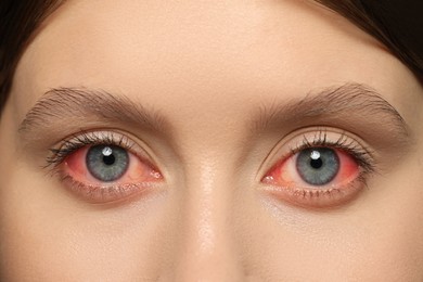 Closeup view of woman with inflamed eyes