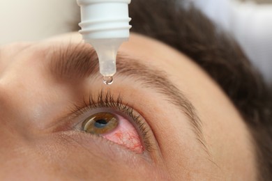 Closeup view of man with inflamed eyes using drops