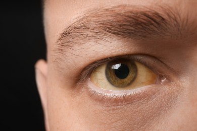 Man with yellow eyes on black background, closeup. Liver problems symptom