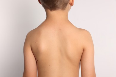 Closeup of boy's body with birthmarks on light grey background, back view