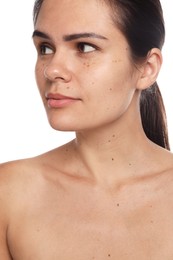 Beautiful woman with birthmarks on white background