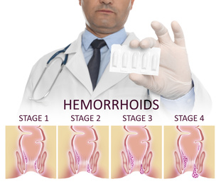 Doctor holding suppositories for hemorrhoid treatment over illustration of lower rectum progressing disease