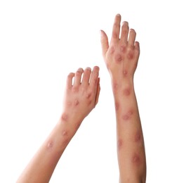 Woman with rash suffering from monkeypox virus on white background, closeup