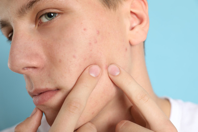 Teen guy with acne problem squeezing pimple on light blue background, closeup