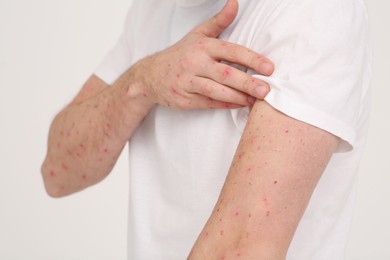 Photo of Man with rash suffering from monkeypox virus on beige background, closeup