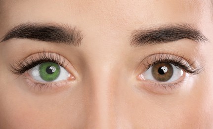 Woman with different colors of eyes, closeup. Heterochromia iridis