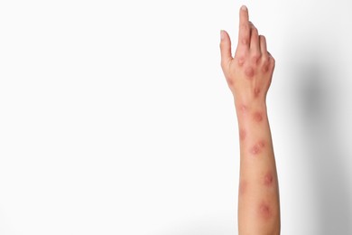 Photo of Woman with rash suffering from monkeypox virus on white background, closeup. Space for text