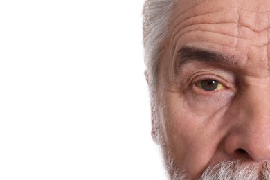 Senior man with yellow eyes on white background, closeup. Symptom of hepatitis