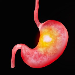 Illustration of Illustration of diseased stomach on black background. Gastroenterology