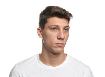 Photo of Teen guy with acne problem on white background