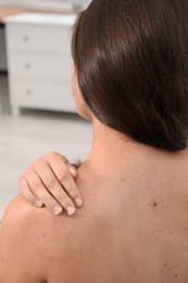 Closeup of woman`s body with birthmarks indoors, back view