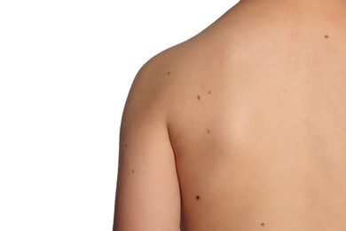 Closeup of boy's body with birthmarks on light grey background, back view. Space for text