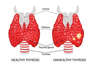Illustration of Illustration of healthy and diseased thyroid on white background